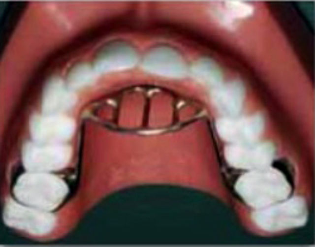 Protector dental de empuje de lengua