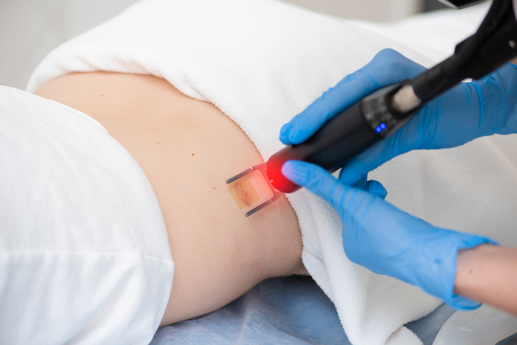 Laser Therapy procedure