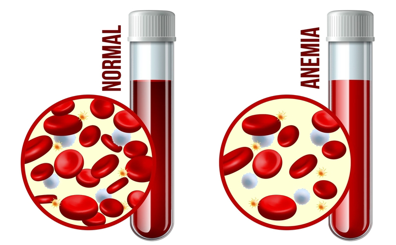 Anemia Of Chronic Disease Causes Symptomsand Treatment 8034