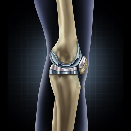 artificial joint replacement