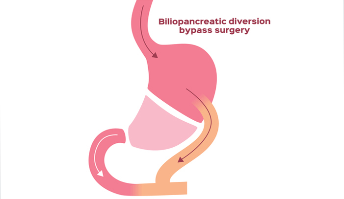 Phẫu thuật chuyển dòng mật tụy với đường chuyển tá tràng (BPD / DS)