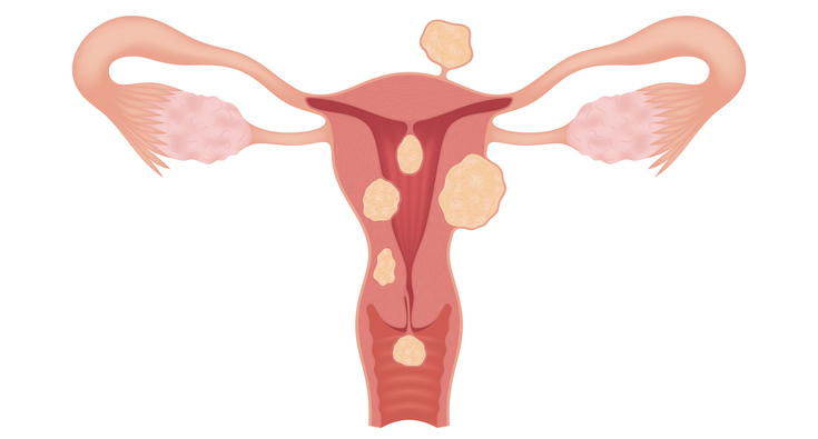 surgical-removal-of-submucosal-fibroids-in-melbourne-dr-kent-kuswanto