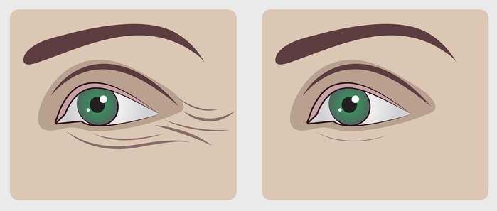 causes under eye wrinkles