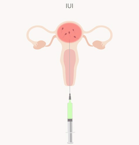 Intrauterine insemination Definition
