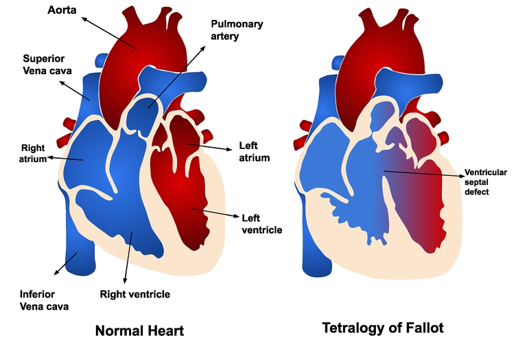 Tetralogy of Fallot in Children