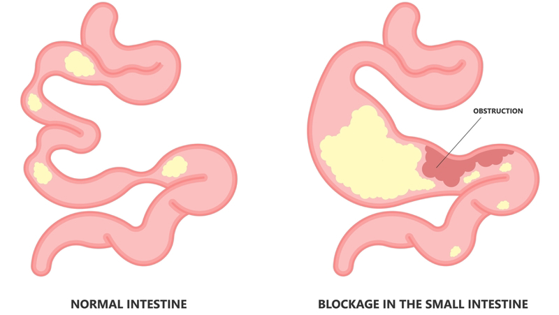 Obstrucción intestinal pequeña (SBO)