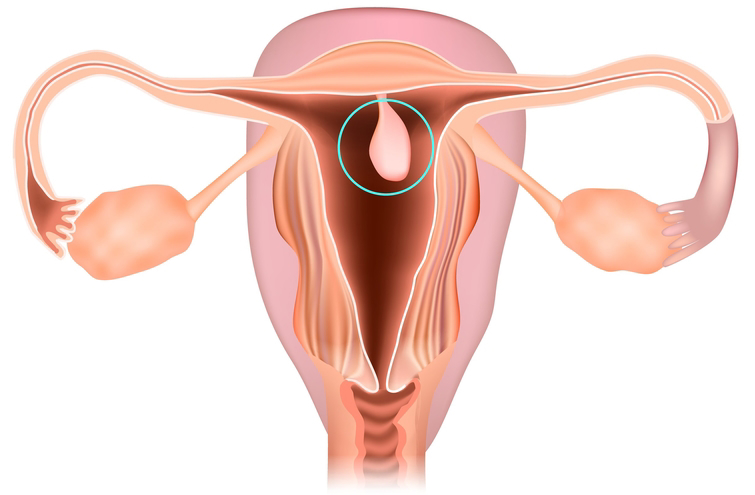 Patogénesis de los pólipos uterinos