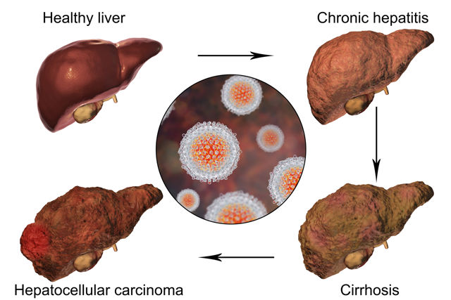 Hepatocellular carcinoma Etiology 