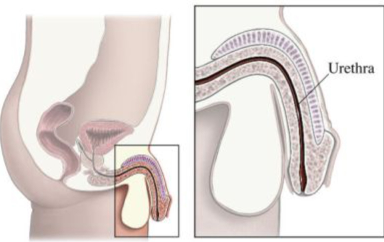 Urethral Stricture Disease