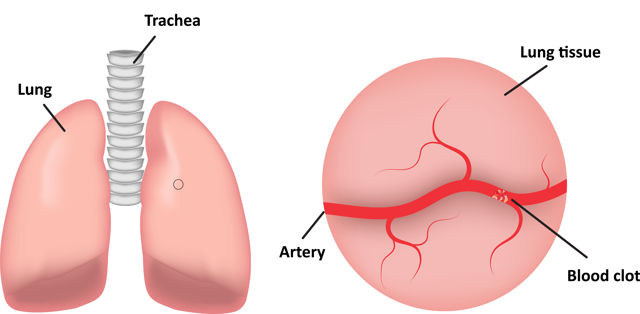 pulmonary-embolism-pe