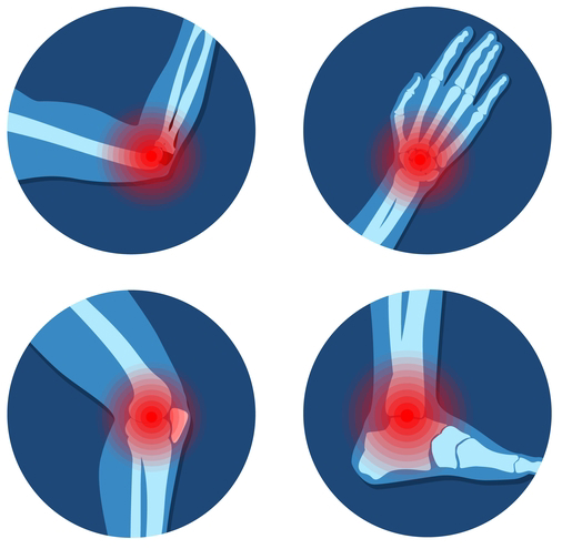Joint Disorders