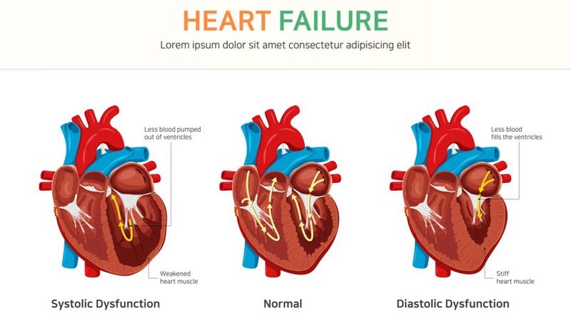 Ventricular Systolic Dysfunction