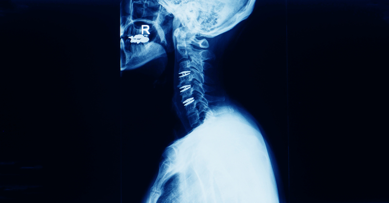 What is Cervical Disc Replacement?