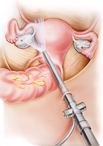 Tipos de endoscopia ginecológica