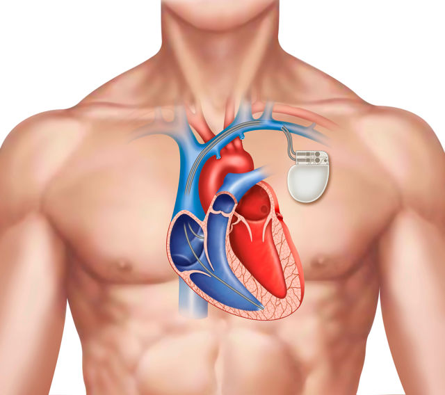Определение кардиостимулятора