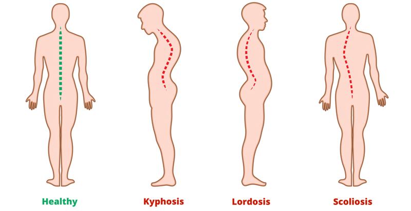Ejemplos de deformidades espinales