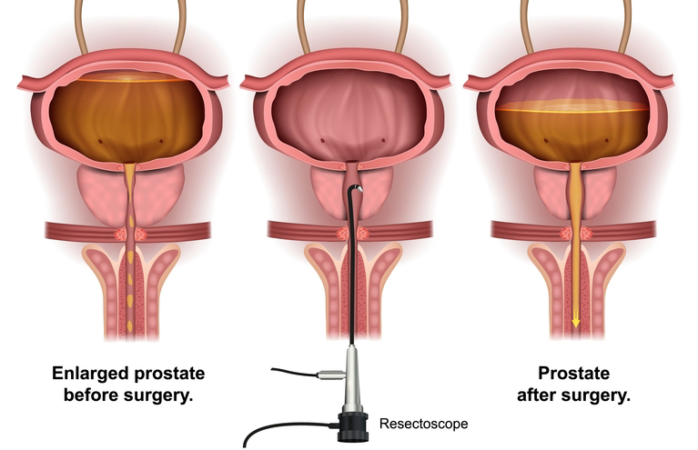Resección transuretral de próstata (RTUP)