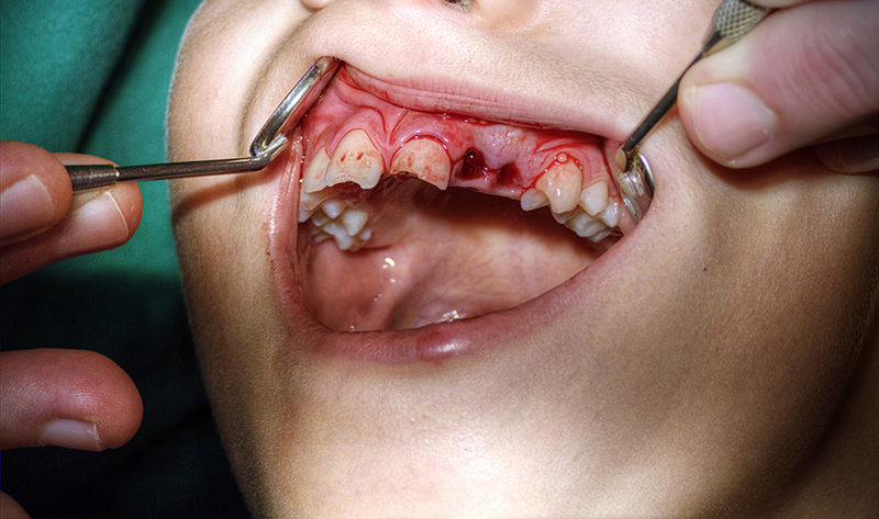 định nghĩa trồng lại răng