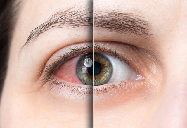 распространен синдром сухого глаза
