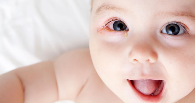 Preventing Conjunctivitis in Newborns