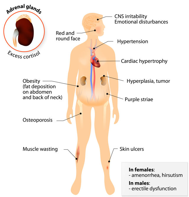 Cushings Syndrome 