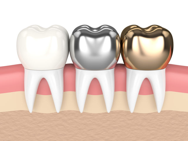Types of Dental Crown