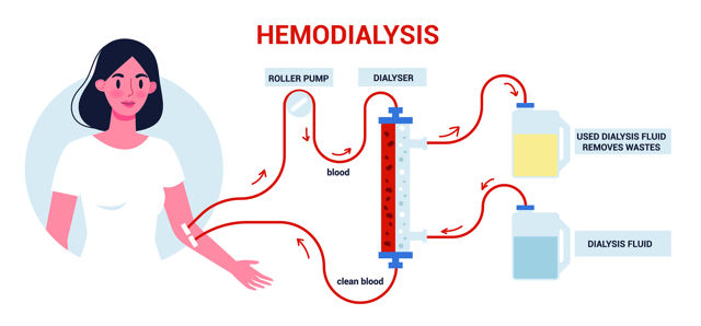 2-Hemodialysis-0641c0f8-e592-4db3-9052-58bf445eca95.jpg