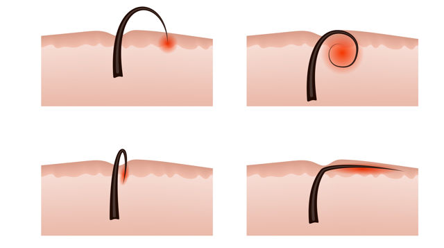 What to do if you have an infected ingrown hair  Patient