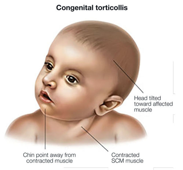 Congenital torticollis