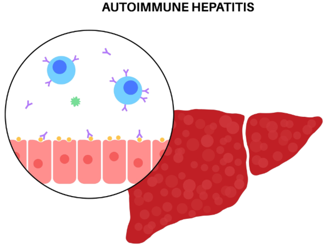 Autoimmune hepatitis
