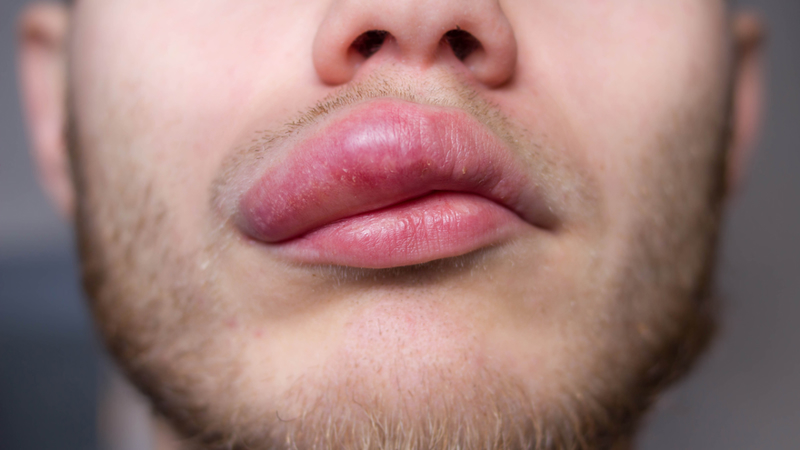 Angioedema Causes Types And Treatments 