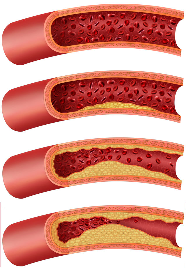 Патофизиология периферических артерий