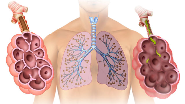 Pathophysiology of emphysema