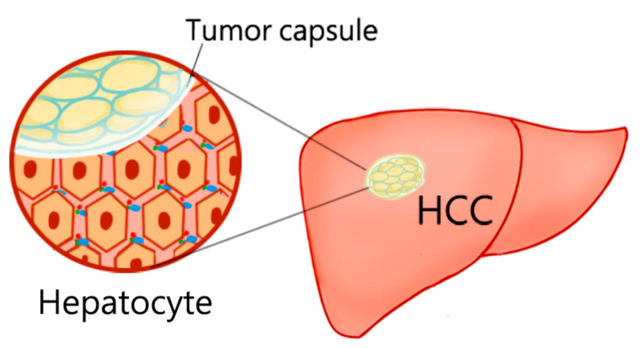 Hepatocellular carcinoma Pathophysiology