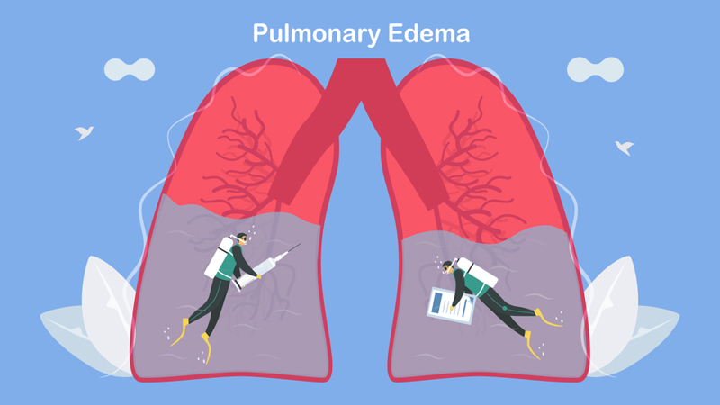 Managing Acute Cardiogenic Pulmonary Edema