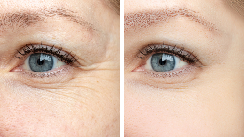 Types of Eye wrinkles