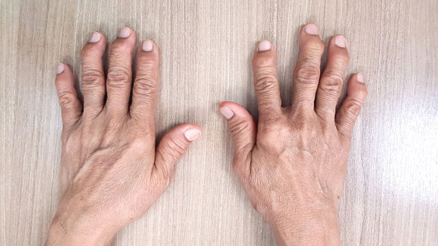 ¿Qué es la artritis degenerativa?