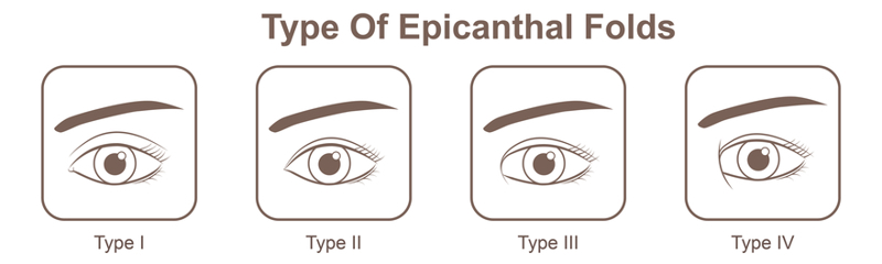 Gấp Epicanthal