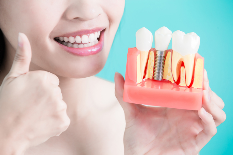 Beneficios del Nuevo Implante Dental Astra