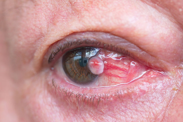 Triệu chứng khối u mắt