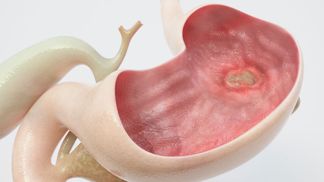 Comment l’ulcère gastrique se produit-il