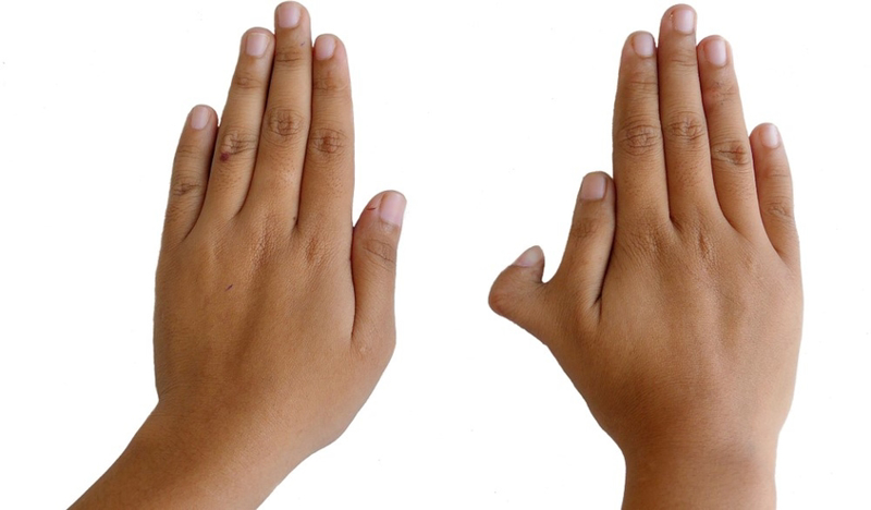 webbed-fingers-and-toes-syndactyly