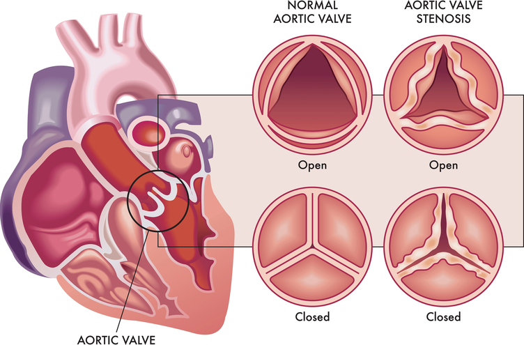 heart-valve-disease