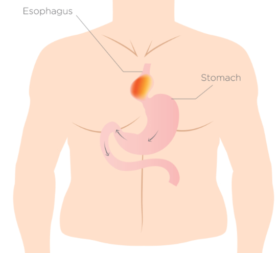 Gastrocele (Stomach Hernia)