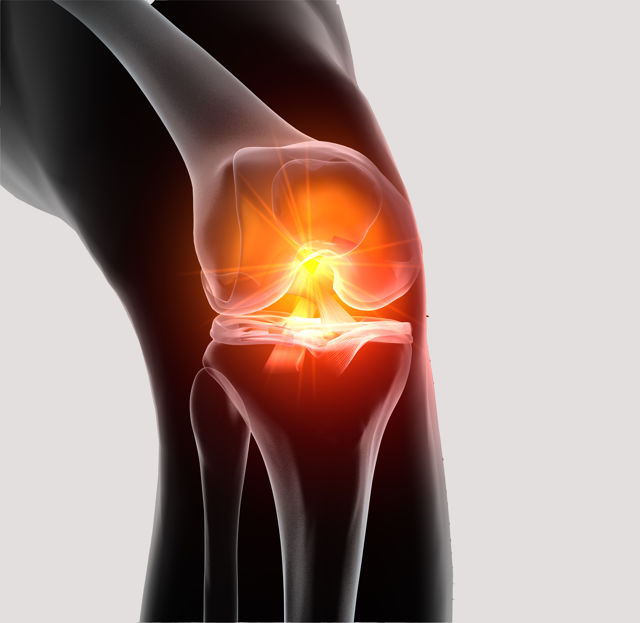 Anterior cruciate ligament reconstruction (ACL reconstruction)