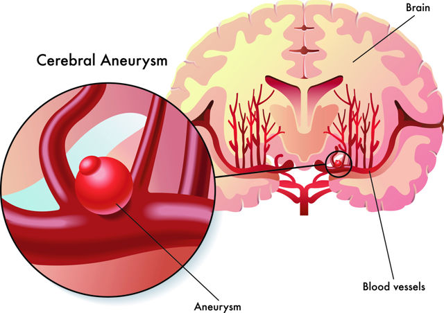 Brain (Cerebral) Aneurysm: Causes, Symptoms and Treatment