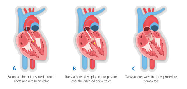 Interventional Cardiology