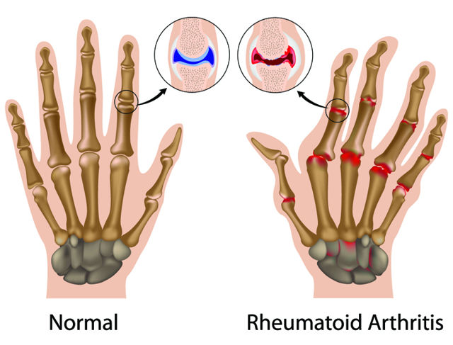 Rheumatoid Arthritis in the Hands