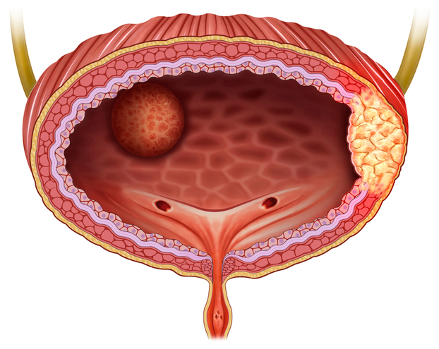 Bladder Removal Surgery