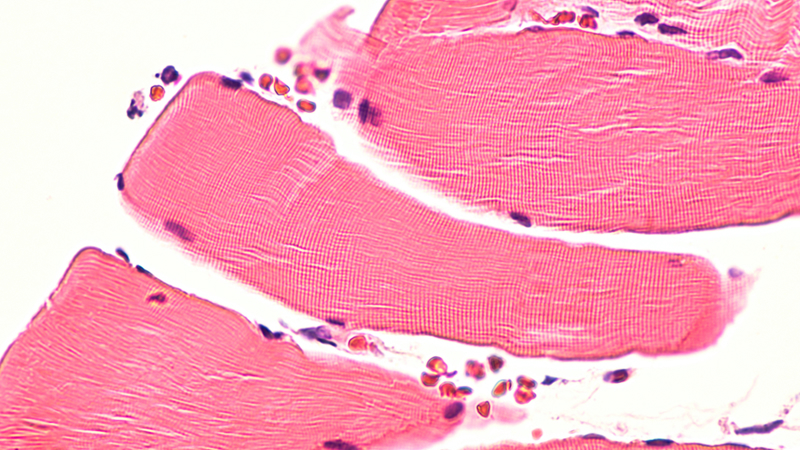 Rhabdomyolysis: Clinical manifestations and diagnosis